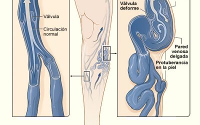 La enfermedad venosa: prevención y tratamiento