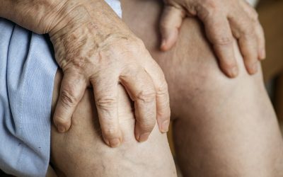 ¿Qué son las varices reticulares y cómo tratarlas?