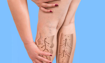 Què és la dermatitis per estasi o èczema venós?