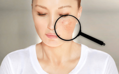 Aranyes Vasculars a la cara: causes i tractament