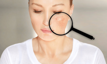 Aranyes Vasculars a la cara: causes i tractament