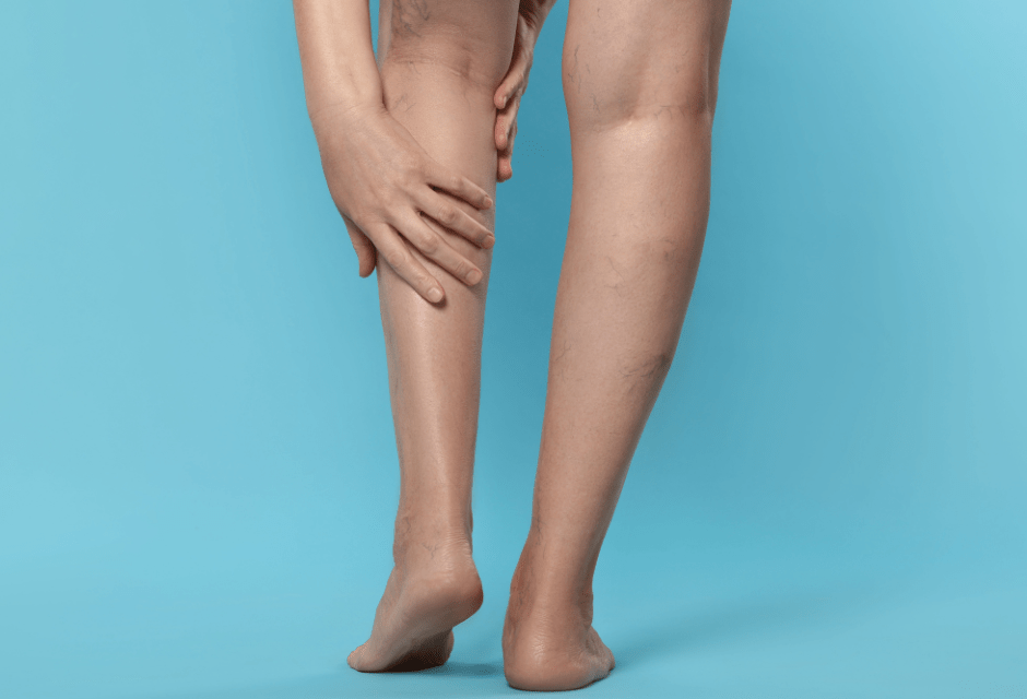 Adiós a las arañitas en las piernas con la escleroterapia con espuma