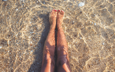 ¿Por qué las varices empeoran en verano?