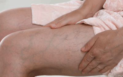 Per què fan mal les varius a les cames i quin paper juguen els canvis hormonals?
