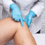 Las arañas vasculares, ¿son realmente varices?